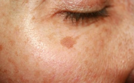 Sun Damage Starts Deep Below Skin Surface, New Dermatology Report Finds