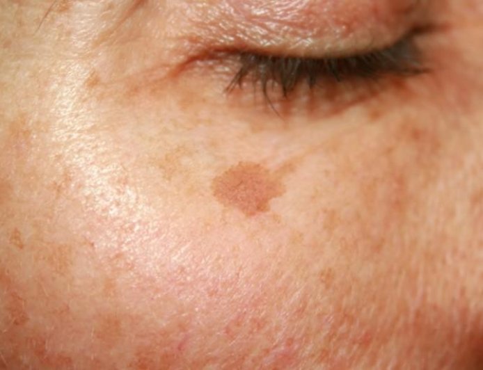 Sun Damage Starts Deep Below Skin Surface, New Dermatology Report Finds