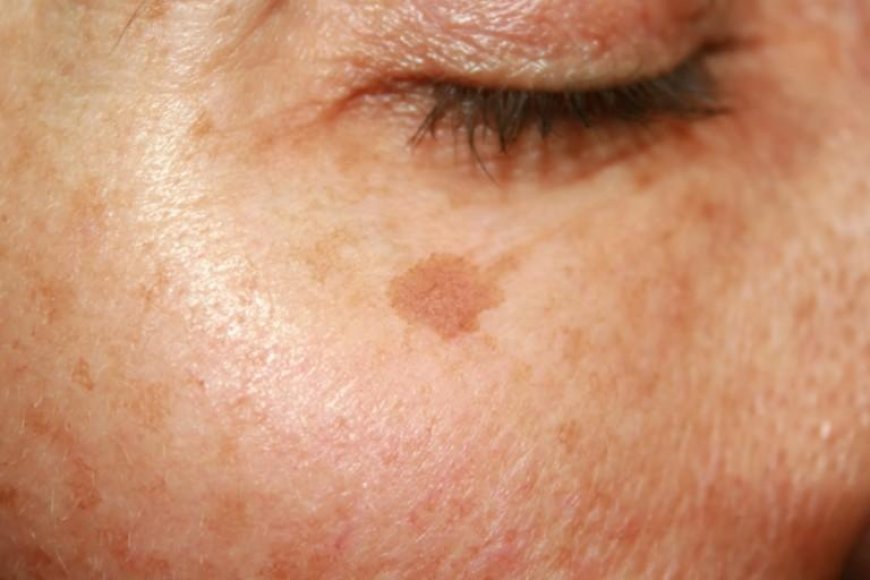 Sun Damage Starts Deep Below Skin Surface, New Dermatology Report Finds